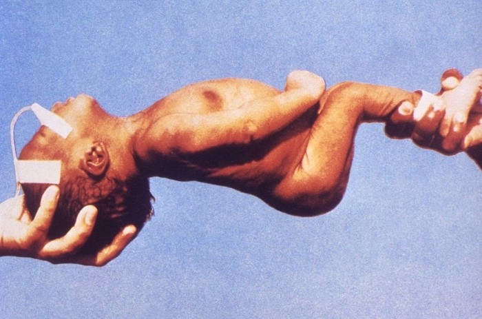 столбняк столбняк