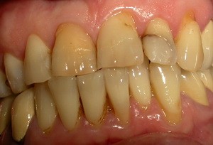 Желтые зубы