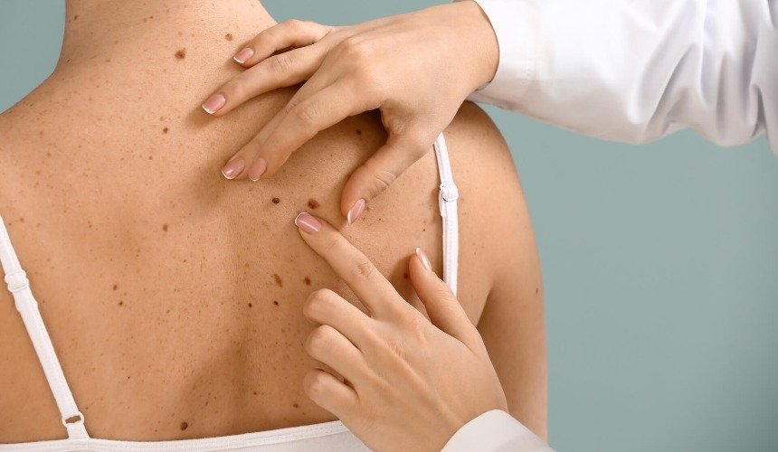 Много родинок на спине 