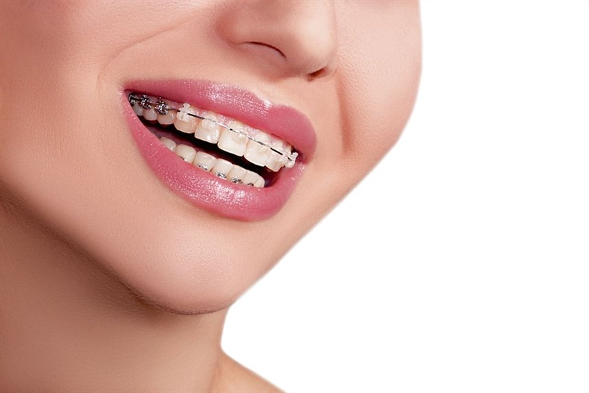 ulibka_breketi ulibka_breketi