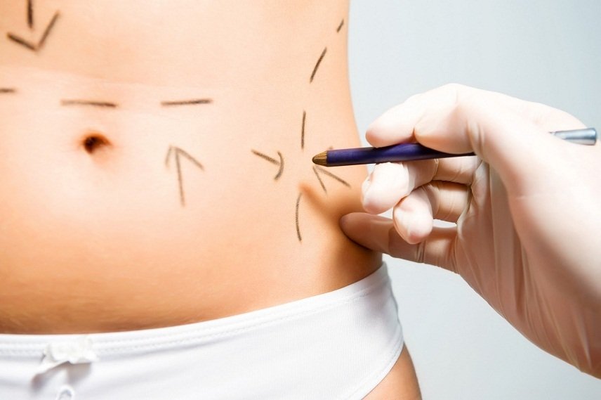 abdominoplastika abdominoplastika