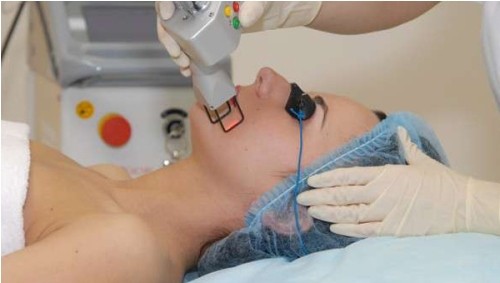 Лазерное омоложение