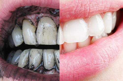 Профессиональное и домашнее отбеливание зубов гелем