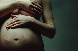 Кесарево сечение: сколько стоит «обман» природы.