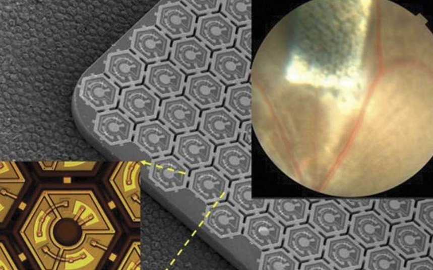 Бионические импланты